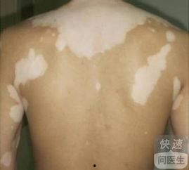 白癜风吃茭瓜好吗,茭瓜对白癜风患者饮食的影响探讨